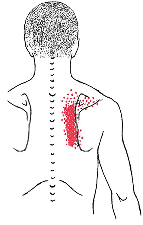Smerter under skulderblad venstre side